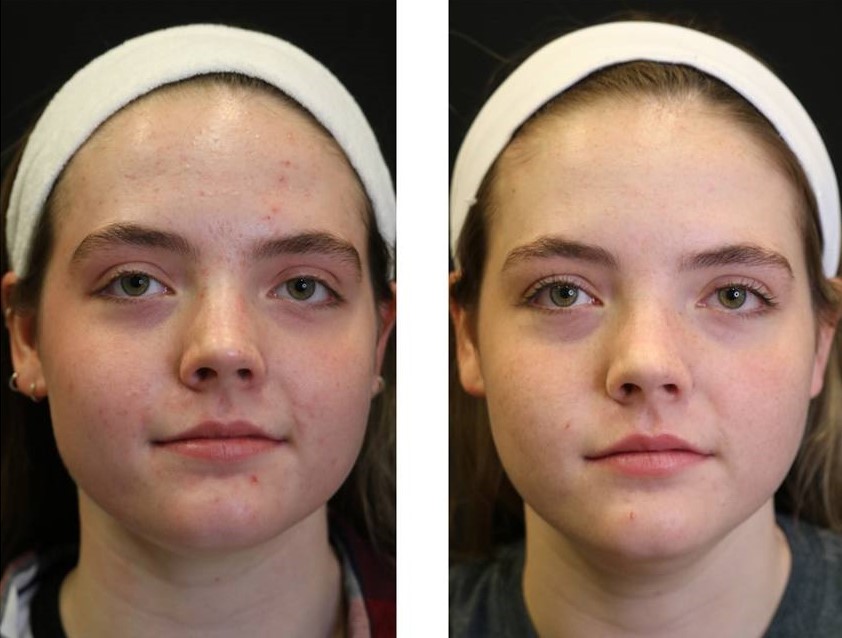 salt facial before and after. 6 treatments
