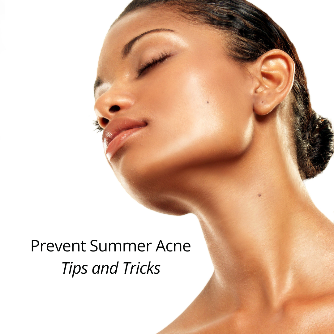how to prevent summer acne tips and tricks