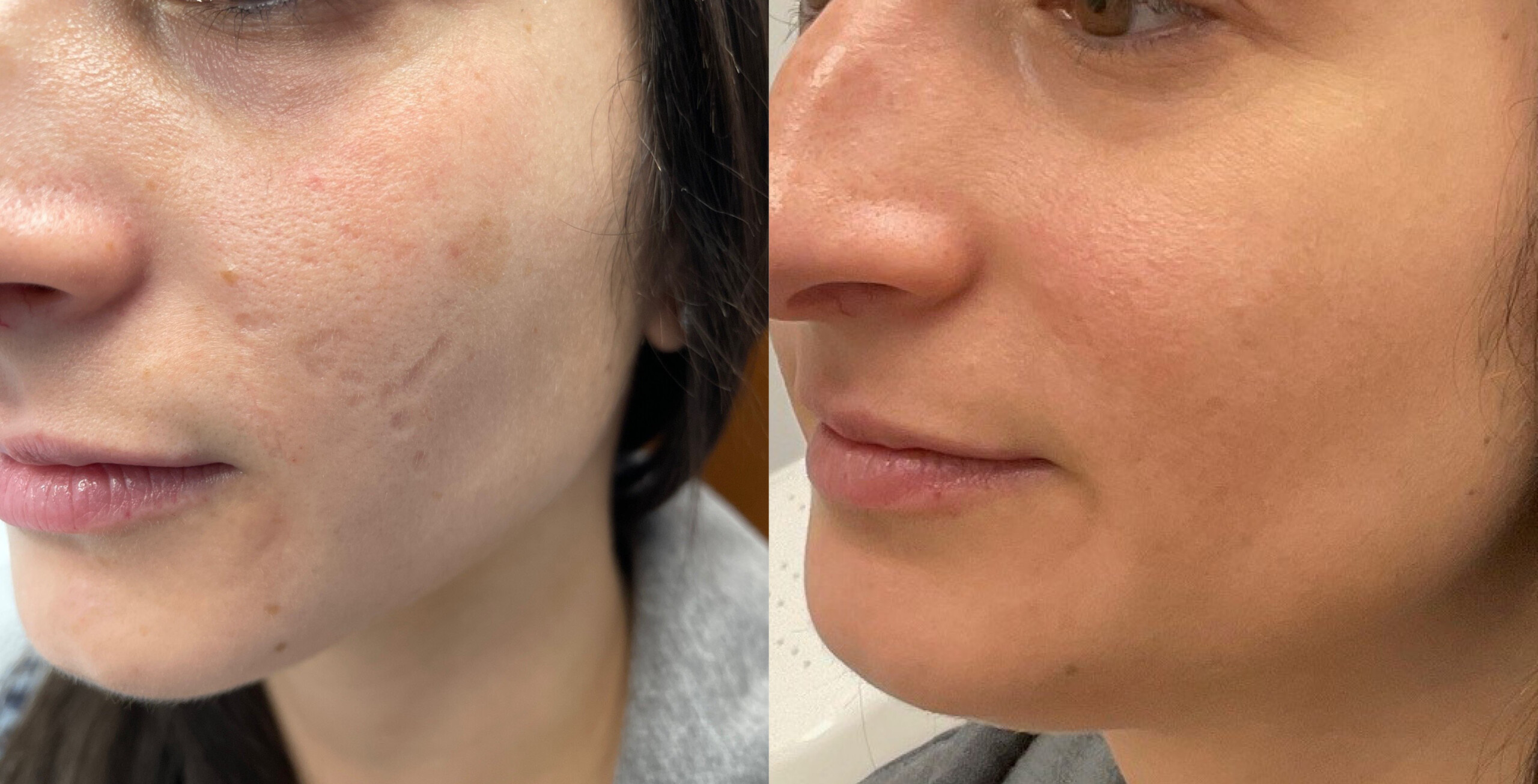 Fraxel-and-chem-peels-for-acne-scarring