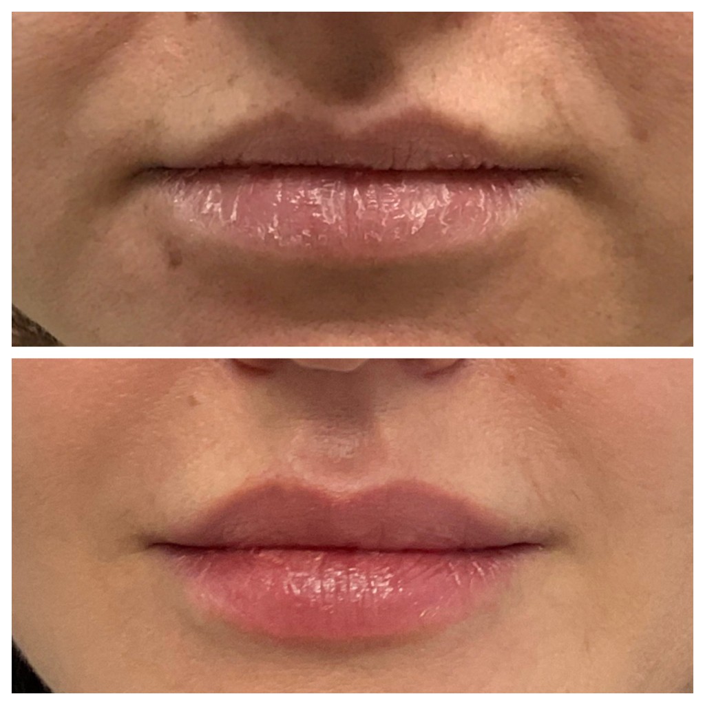 Before and After: Lip Fillers